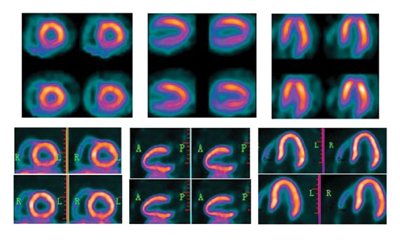 PET vs. SPECT, nuclear imaging advances with BFPET