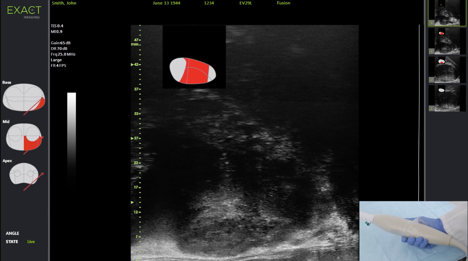 MRI Targeted biopsy is performed using cognitive fusion more easily with anatomical guidance based on the radiology report. MRI targets can be identified quickly in real-time along with micro-ultrasound targets, which may have been missed on MRI.