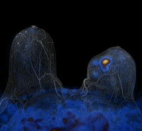 breast cancer image from Philips Ingenuity TF PET/MR system breast cancer image from Philips Ingenuity TF PET/MR system