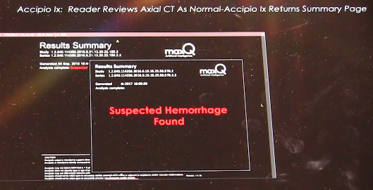 MaxQ AI Accipio hemorrhagic stroke detection software. MaxQ.AI