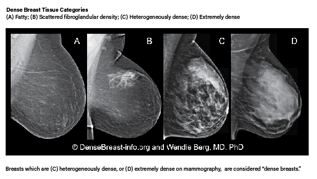 Mammogram Guidelines for Dense breast tissue 