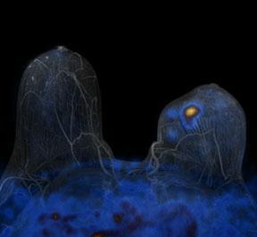 breast cancer image from Philips Ingenuity TF PET/MR system