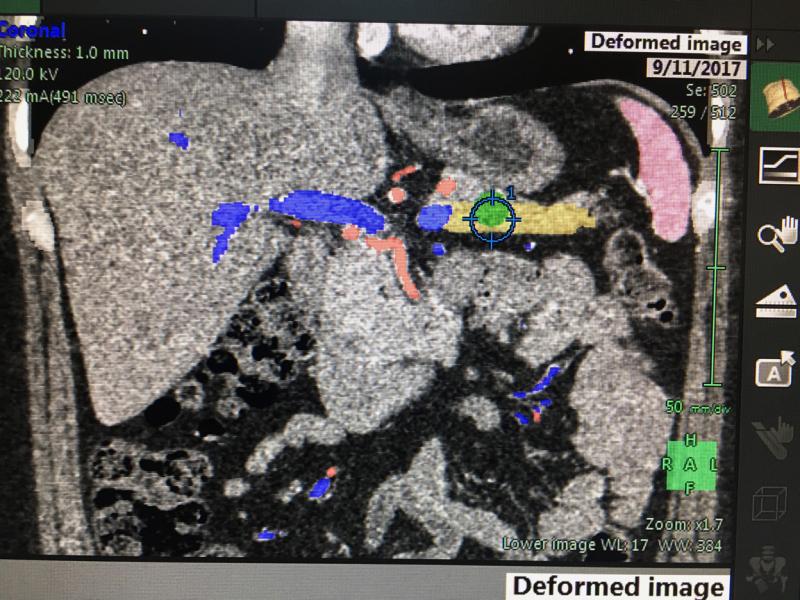 Semi-automated anatomical labeling can aid navigating complex anatomy, as shown here in finding the pancreas (in yellow). The green dot is a tumor. Color coding anatomy like this helps speed workflow and makes areas of interest easier to find for referring physicians, radiation oncologists and surgeons. This is an example show by Fujifilm at HIMSS 2019.