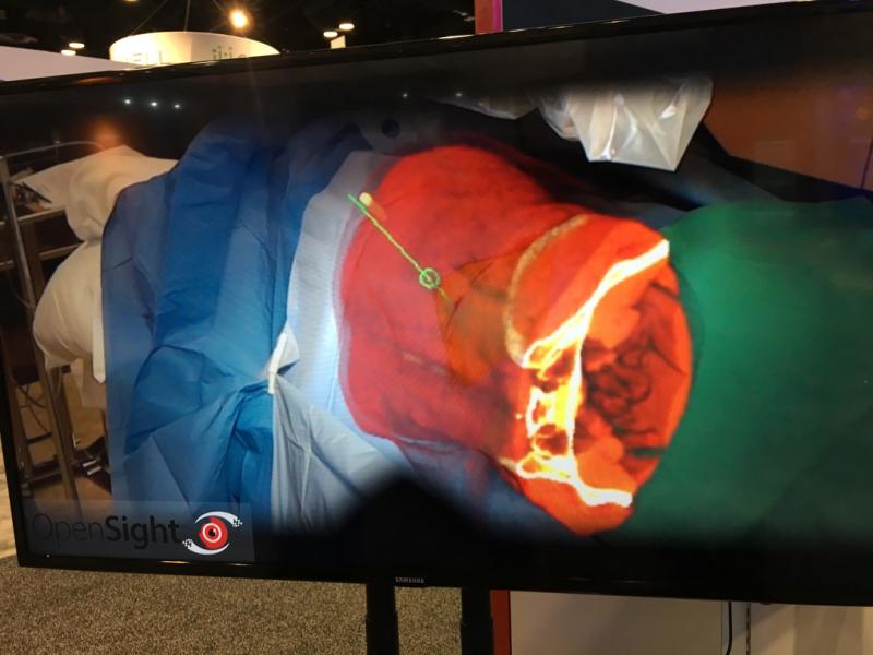 Examples of Augmented reality offered as an FDA-cleared product by NovaRad at HIMSS 2019 last week.The system integrates MRI or CT imaging datasets into a HoloLens headset and landmarks are registered to the patient on an operating table. The user can make hand gestures in mid air to scroll through the image slides. The goal of the system is to allow for surgical planning.