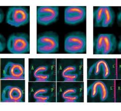PET vs. SPECT, nuclear imaging advances with BFPET