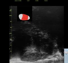 MRI Targeted biopsy is performed using cognitive fusion more easily with anatomical guidance based on the radiology report. MRI targets can be identified quickly in real-time along with micro-ultrasound targets, which may have been missed on MRI.