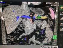 Semi-automated anatomical labeling can aid navigating complex anatomy, as shown here in finding the pancreas (in yellow). The green dot is a tumor. Color coding anatomy like this helps speed workflow and makes areas of interest easier to find for referring physicians, radiation oncologists and surgeons. This is an example show by Fujifilm at HIMSS 2019.
