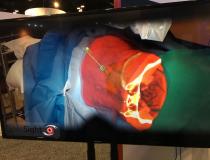 Examples of Augmented reality offered as an FDA-cleared product by NovaRad at HIMSS 2019 last week.The system integrates MRI or CT imaging datasets into a HoloLens headset and landmarks are registered to the patient on an operating table. The user can make hand gestures in mid air to scroll through the image slides. The goal of the system is to allow for surgical planning.